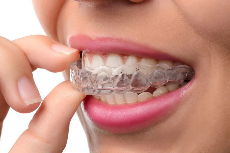 ADVANTAGES OF CLEAR BRACES FOR TEENAGERS HAWTHORN
