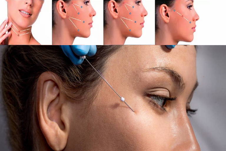 Non-Surgical Lifting Results with Thread Face Lift